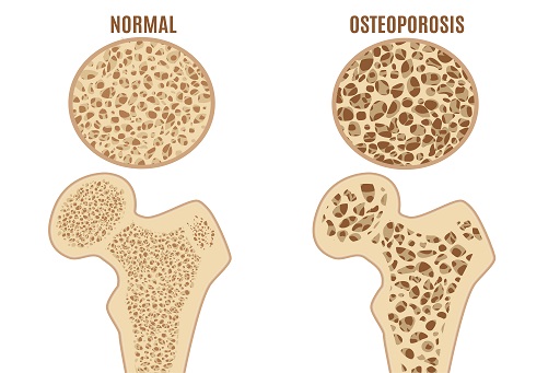 Osteoporose