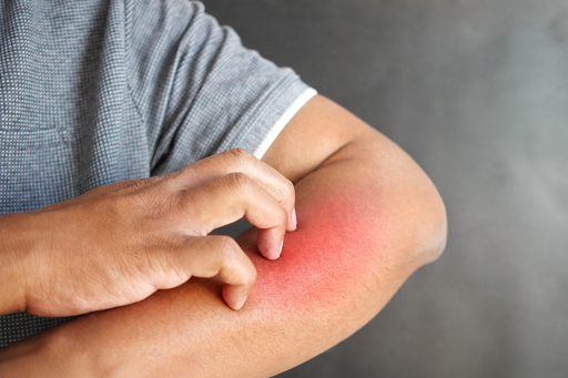 Alergia a Acrilato