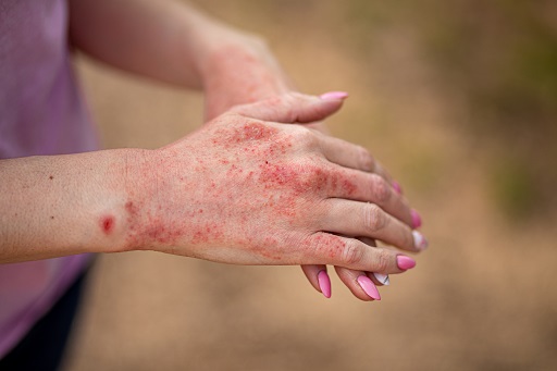 Alergia aos Antibióticos à Base de Sulfonamida