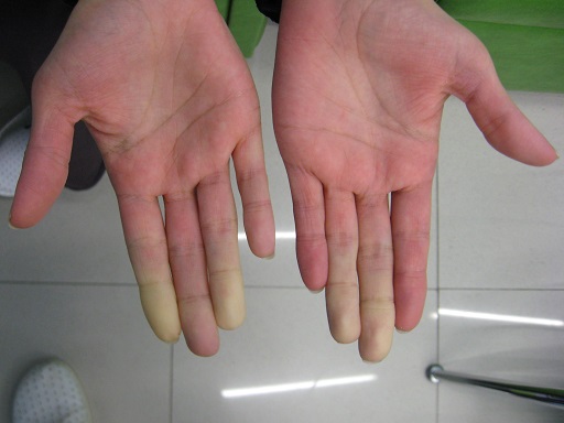 Doença de Raynaud