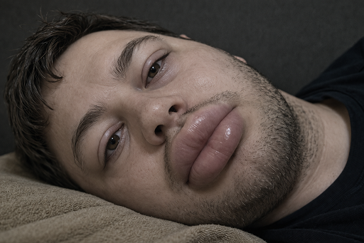 Edema Facial