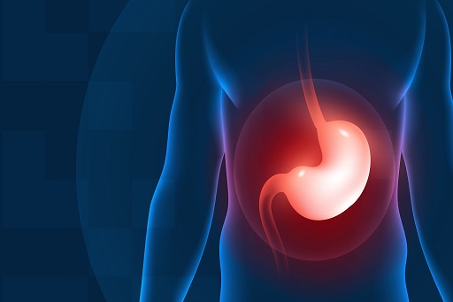 Úlcera Duodenal