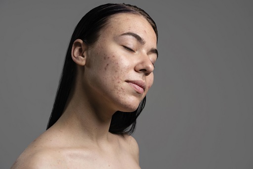 Acne em pacientes com colite ulcerativa ou retocolite ulcerativa (RCU)