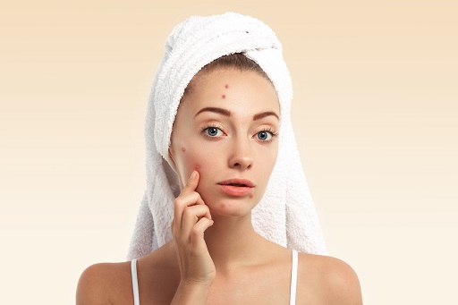 Acne em pacientes com dermatite atópica