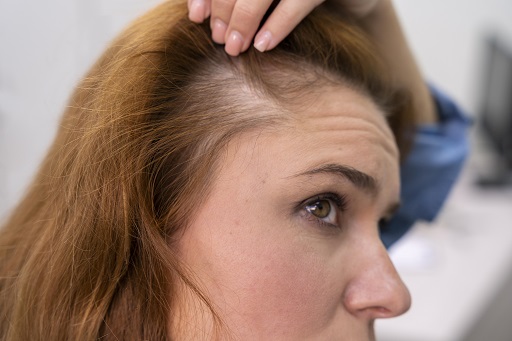 Alopecia areata