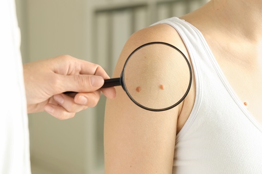 Câncer de pele não melanoma em pacientes com colite ulcerativa ou retocolite ulcerativa (RCU)
