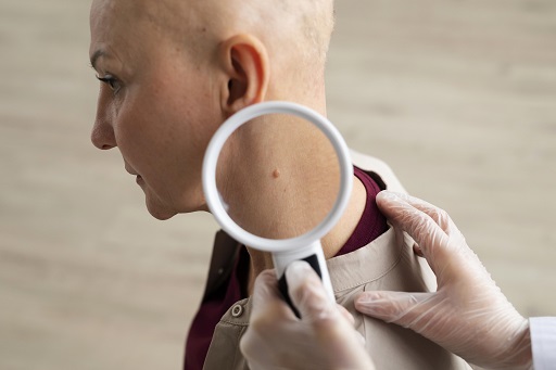 Câncer de pele não melanoma em pacientes com dermatite atópica