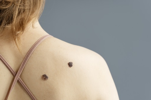 Câncer de pele não melanoma em pacientes com doença de crohn