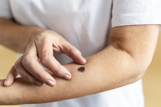 Câncer de pele não melanoma