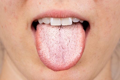 Candidíase oral em pacientes com artrite reumatoide