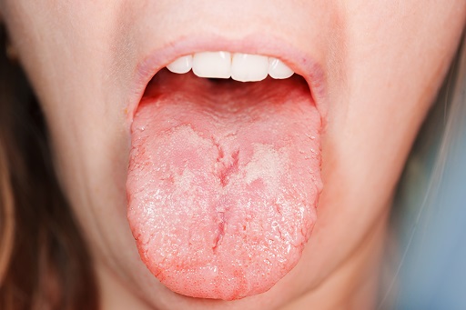 Candidíase oral em pacientes com doença de crohn