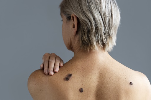 Carcinoma basocelular
