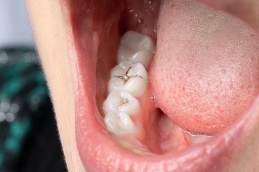 Caries dentais