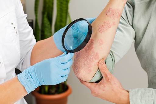 Eczema herpético