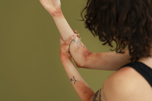 Eczema herpético em pacientes com dermatite atópica