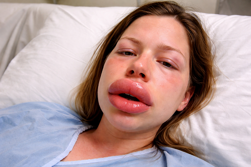 Edema angioneurótico