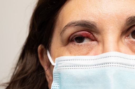 Edema palpebral