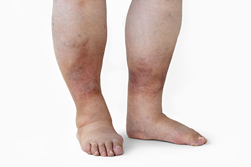 Edema periférico