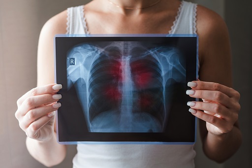 Fibrose pulmonar intersticial