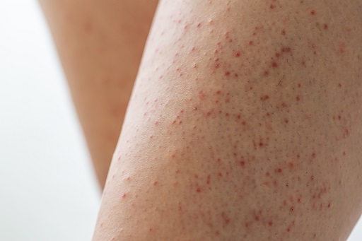 Foliculite em pacientes com dermatite atópica