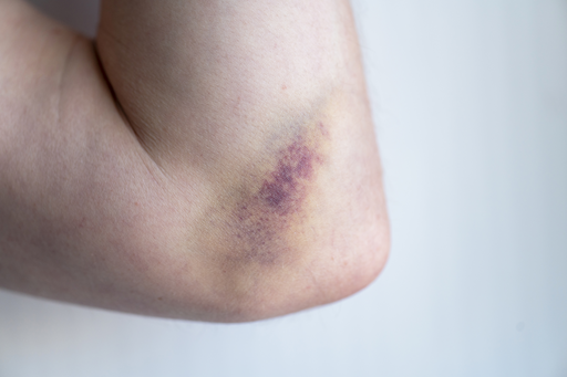 Hematomas