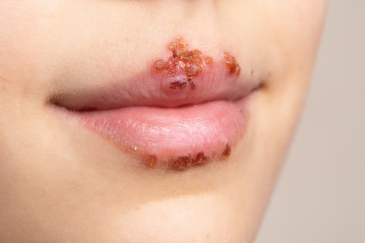 Herpes simples em pacientes com artrite reumatoide