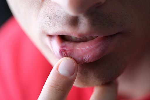 Herpes simples em pacientes com colite ulcerativa ou retocolite ulcerativa (RCU)