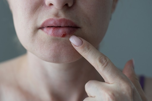 Herpes simples em pacientes com dermatite atópica