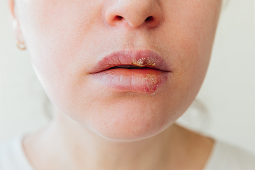 Herpes simplex em pacientes com COVID-19