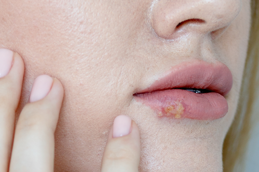 Herpes zoster em pacientes com COVID-19