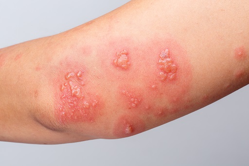 Herpes zoster em pacientes com artrite reumatoide