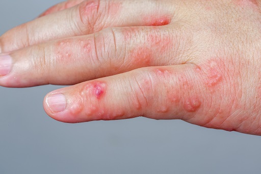Herpes zoster em pacientes com colite ulcerativa ou retocolite ulcerativa (RCU)