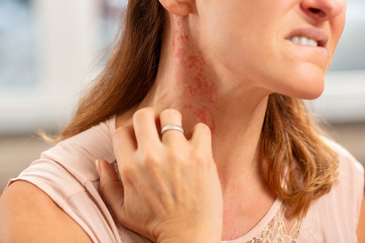 Herpes zoster em pacientes com dermatite atópica
