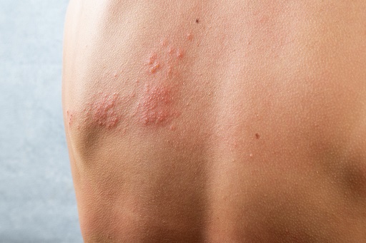 Herpes zoster em pacientes com doença de crohn