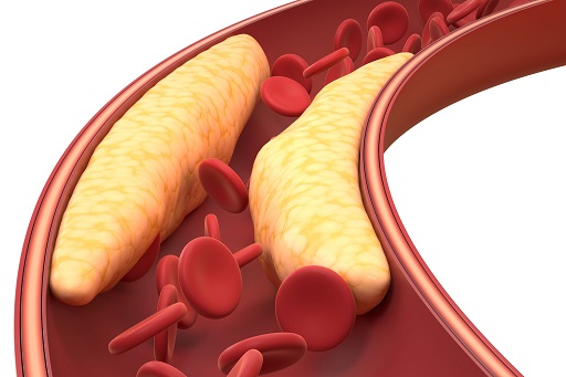 Hipercolesterolemia em pacientes com colite ulcerativa ou retocolite ulcerativa (RCU)