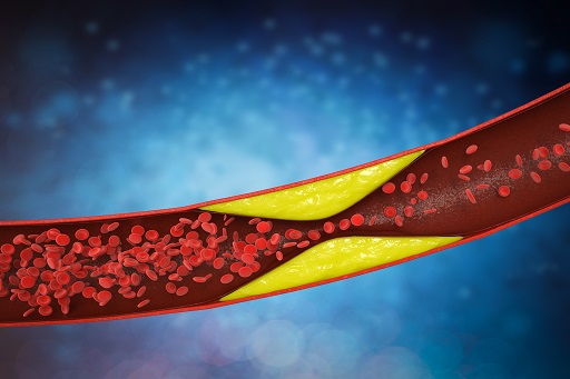 Hipercolesterolemia em pacientes com doença de crohn