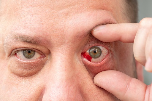 Hiperemia escleral
