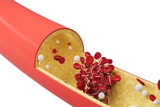 Hiperlipidemia em pacientes com colite ulcerativa ou retocolite ulcerativa (RCU)