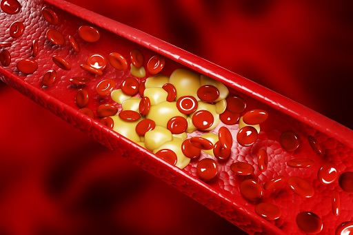 Hipertrigliceridemia em pacientes com artrite reumatoide