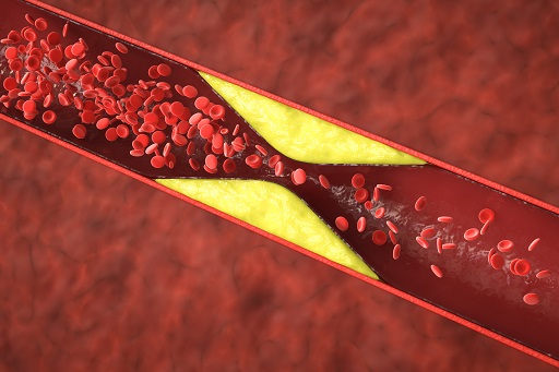 Hipertrigliceridemia em pacientes com dermatite atópica