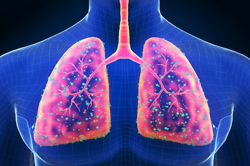 Infecções do trato respiratório superior em pacientes com colite ulcerativa ou retocolite ulcerativa