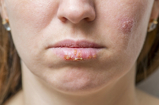 Infecções por herpes