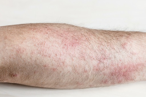 Lúpus eritematoso cutâneo subagudo
