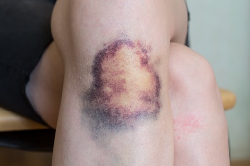 Manchas roxas pelo corpo