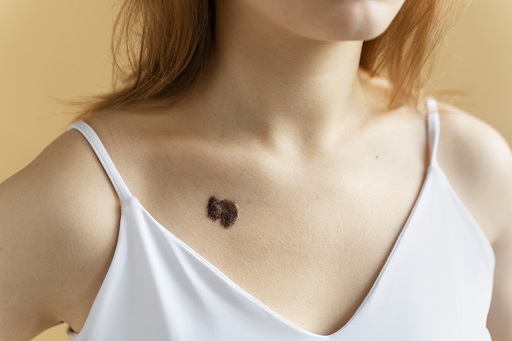 Melanoma maligno