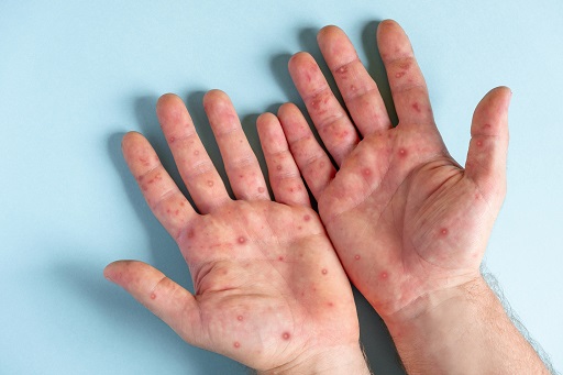 Molusco contagioso