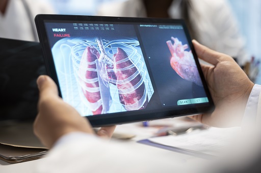 Pneumonia em pacientes com colite ulcerativa ou retocolite ulcerativa (RCU)