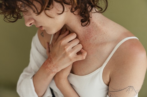 Urticária em pacientes com dermatite atópica
