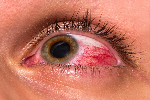 Vermelhidão ocular