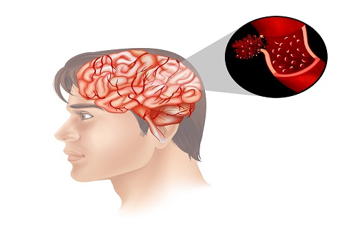 Acidente vascular cerebral (AVC)